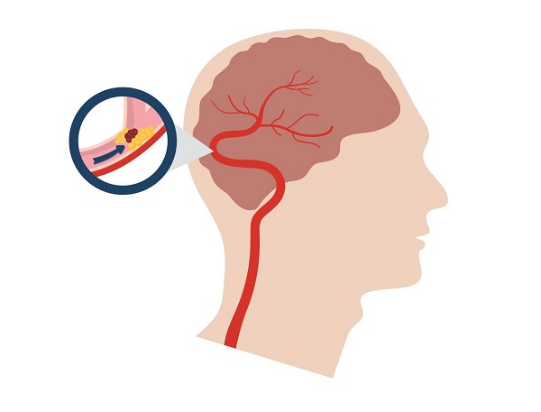 4 dấu hiệu nhận biết thiếu máu não